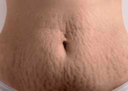 Rougeurs et vergetures sur la peau pendant la grossesse - Sika Cosmétique